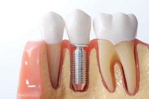 implantologia dentale torino